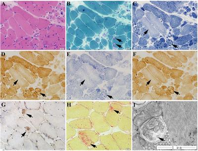 Tcap Deficiency in Zebrafish Leads to ROS Production and Mitophagy, and Idebenone Improves its Phenotypes